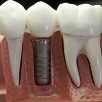 Zahnarzt Zinn Gießen Implantologie